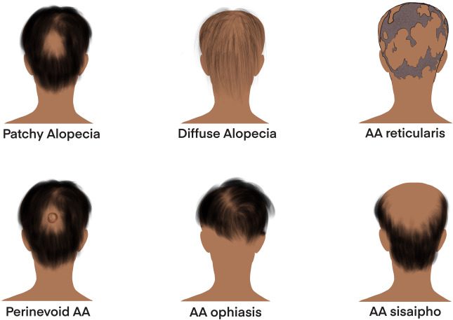 Photo illustrating the condition of alopecia areata with patchy hair loss on the scalp.