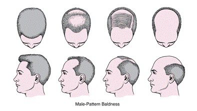 Top view photo of a man’s head showing the typical hair thinning pattern of male pattern baldness.