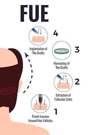 Comprehensive overview photo of the FUE hair transplant technique stages.