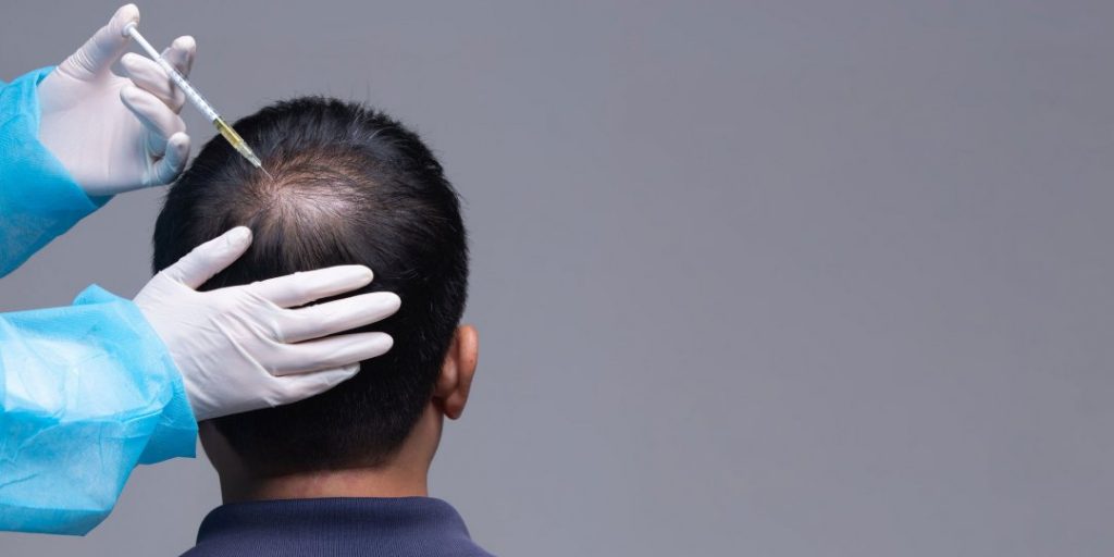 Photo of a patient undergoing PRP therapy for hair loss, with a focus on the scalp treatment area.