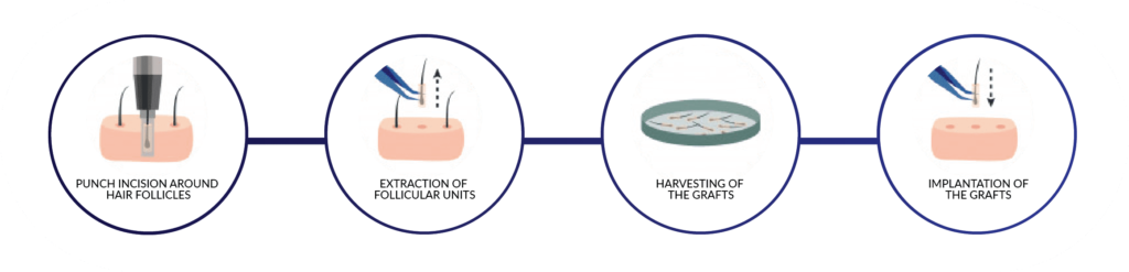 Step-by-step photo series of an FUE hair transplant procedure from extraction to implantation.