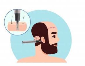 Close-up view of the hair-punching process in a hair transplant surgery, showing precise follicular unit extraction.