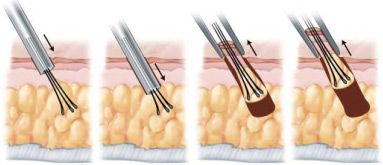 Illustration showing the FUE hair transplant process with individual follicle extraction.