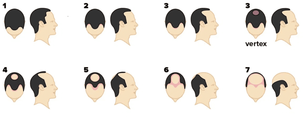 Diagram illustrating the stages of male pattern baldness according to the Norwood scale.