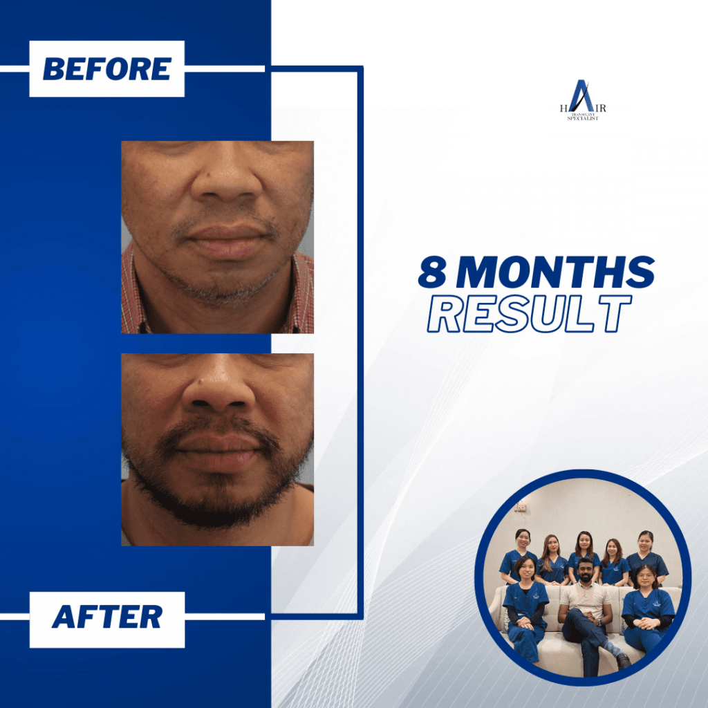 Before and after photos demonstrating the effectiveness of hair regrowth treatment.