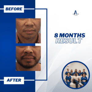 Before and after photos demonstrating the effectiveness of hair regrowth treatment.