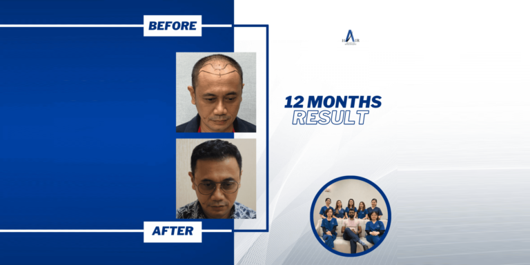 Before and after comparison showcasing a successful 12-month hair restoration journey.