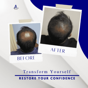 Before and after photos showing the successful results of a hair regrowth treatment.