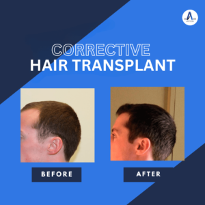 Before and after views of a corrective hair transplant, showing enhanced hair density.