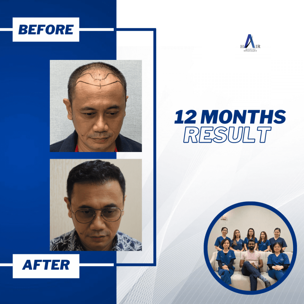Before and after showcase of 12-month hair growth treatment success.