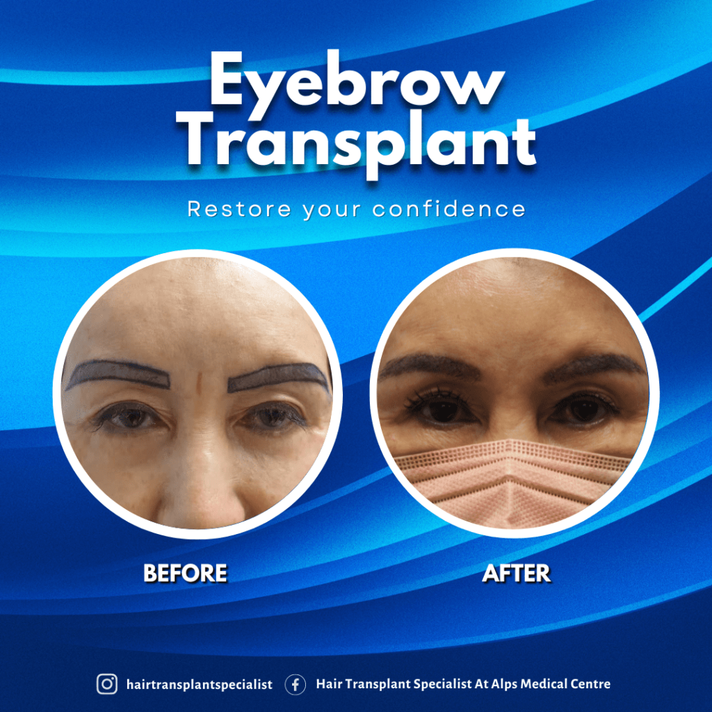 Before and after comparison of eyebrow transplant showing remarkable fullness.