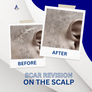 Before and after comparison of scalp scar revision treatment, showing significant improvement.