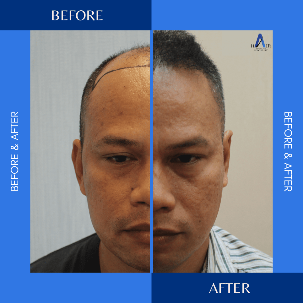 Before and after comparison of a hair transplant procedure.