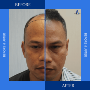 Before and after comparison of a hair transplant procedure.