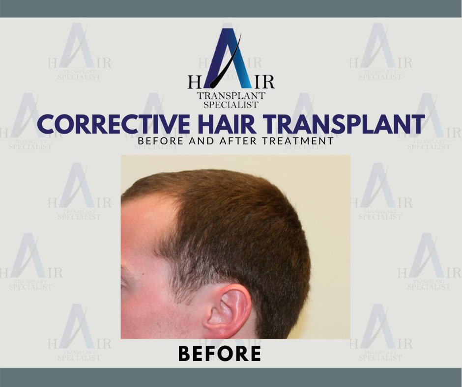 Pre-treatment photo of a patient awaiting corrective hair transplant surgery, showcasing areas of concern.