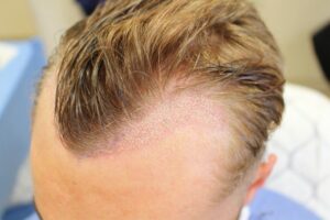 Male patient’s scalp after corrective hair transplant, showing improved hairline and density.