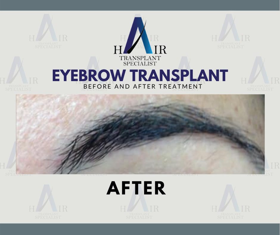 Post-treatment close-up of full, natural-looking eyebrows after a successful transplant.