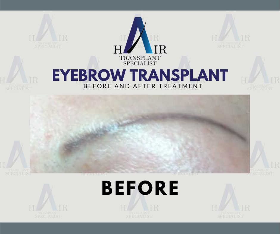 Before-treatment image showing sparse eyebrows in need of enhancement through transplant.