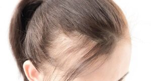 Female patient’s scalp showing improved hairline and density after corrective hair transplant.