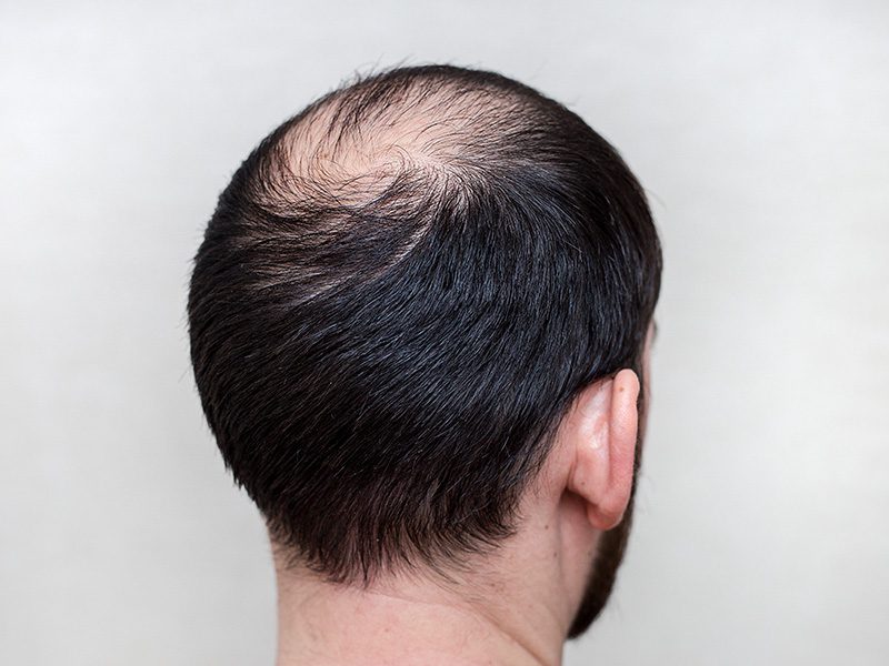 Visible thinning of hair at the crown area indicating early signs of male pattern baldness.