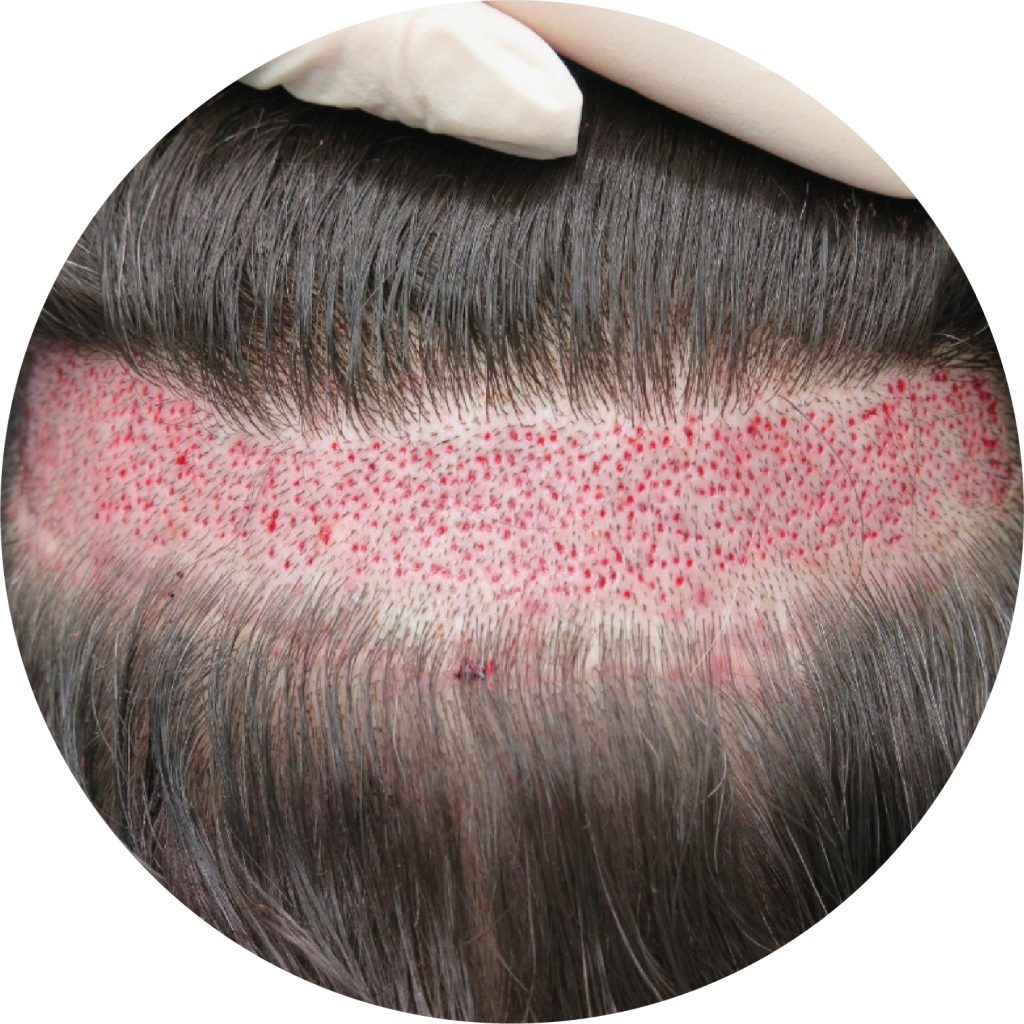 Close-up view of a scalp with parted hair revealing red, raised bumps.