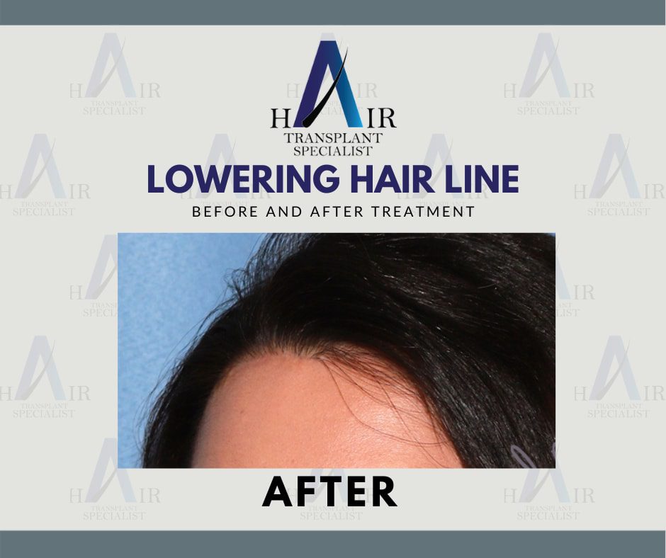 Enhanced facial profile with a newly lowered hairline post-treatment.