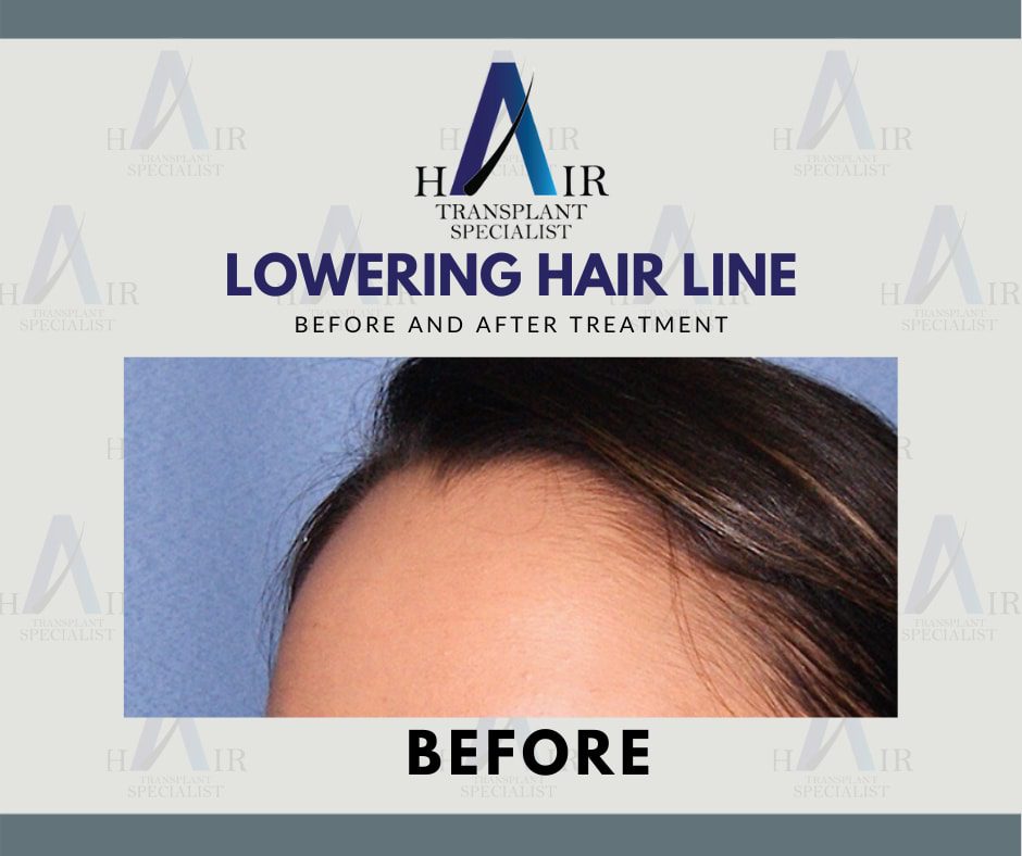 Pre-treatment view of a high hairline, marking the initial stage for hairline lowering surgery.
