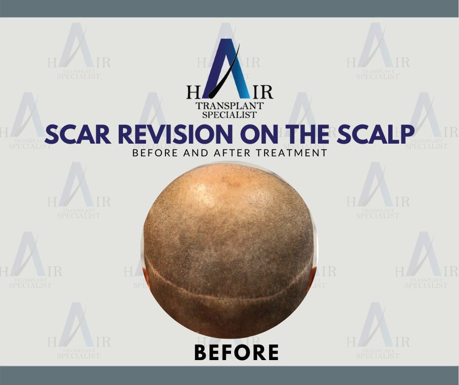 Pre-treatment image of a scalp with visible scar tissue before undergoing revision surgery.