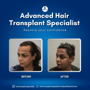 Before and after comparison of hair transplant, showcasing fuller hair post-procedure.