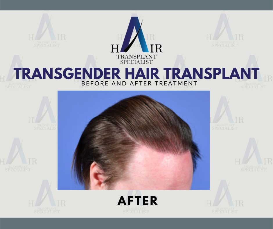 A transgender individual showcasing a full head of hair after a successful hair transplant procedure.
