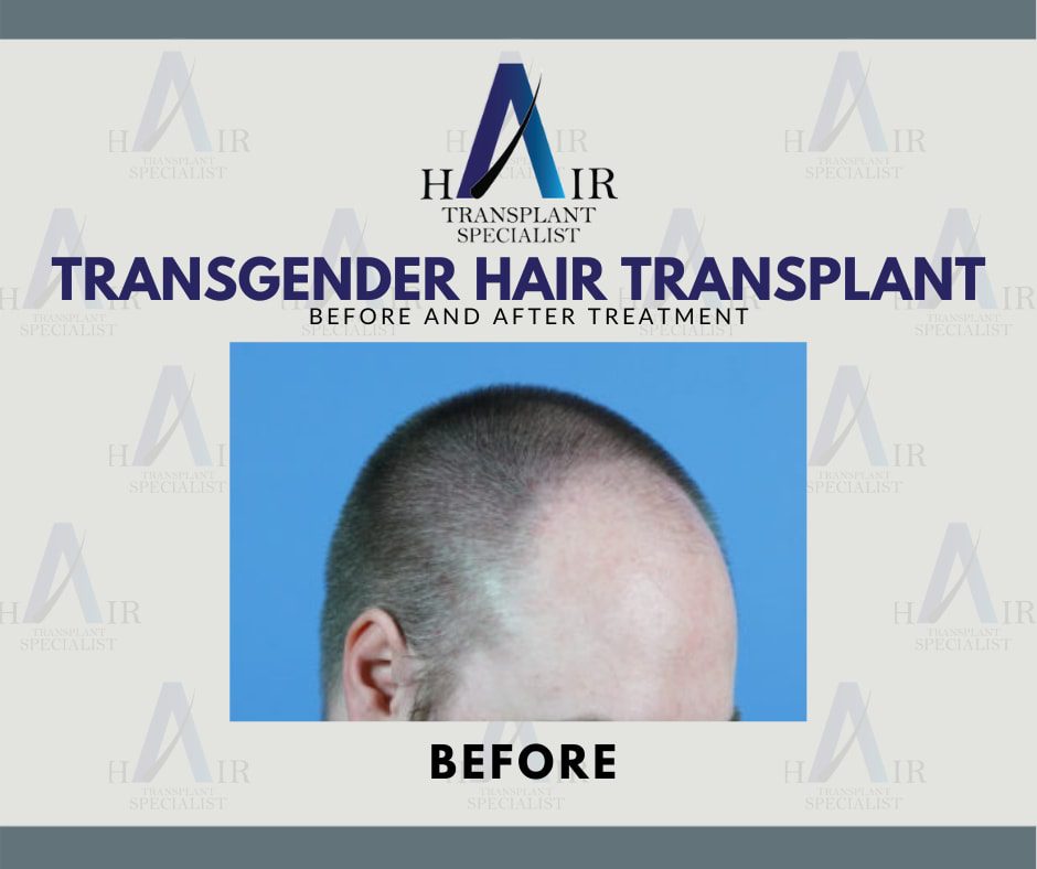 Pre-treatment photograph of a transgender individual showing the initial hairline before hair restoration.