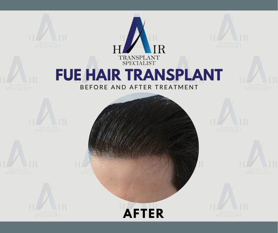 Post-FUE treatment image showcasing a healthy, full head of hair.