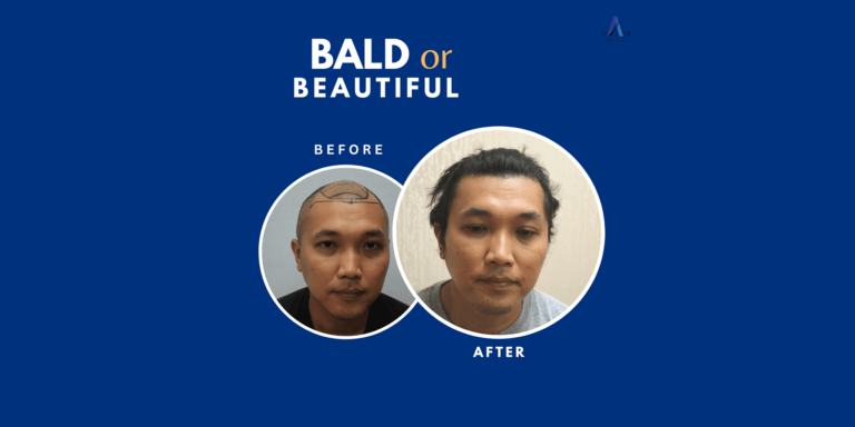 Graphic comparison of hair presence labeled ‘BEFORE’ and baldness labeled ‘AFTER’ against a blue background.