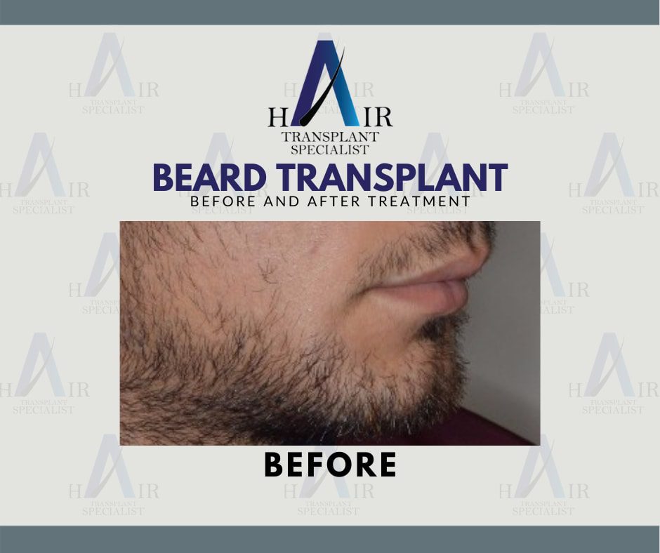 Pre-treatment photo highlighting patchy beard areas targeted for a transplant.