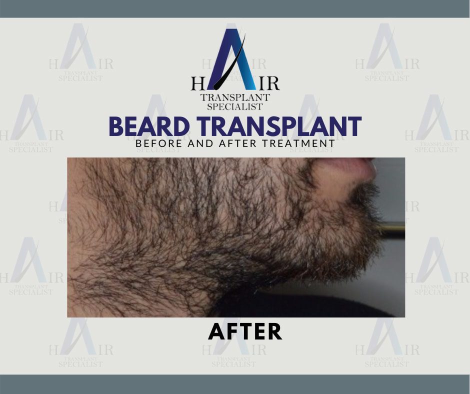 Post-treatment image of a dense, evenly-grown beard from a successful transplant.