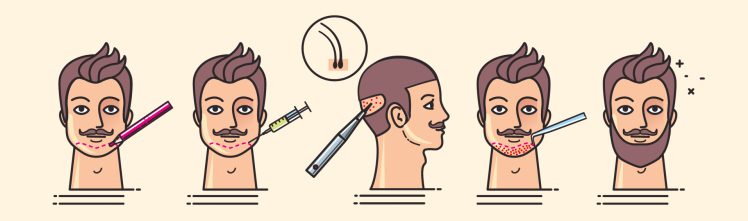Photo capturing the detailed process of a beard transplant, from graft extraction to placement.