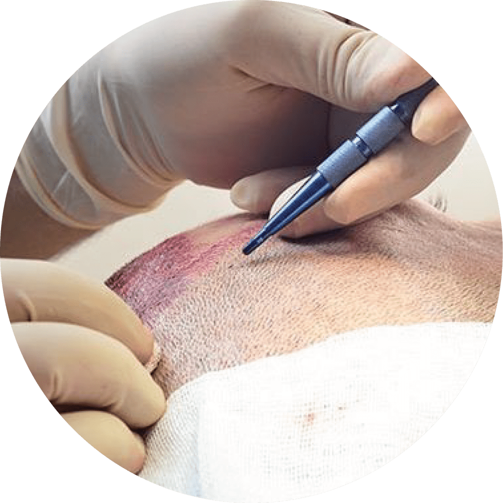 Photo of a patient’s face during beard transplant with marked recipient sites for graft placement.