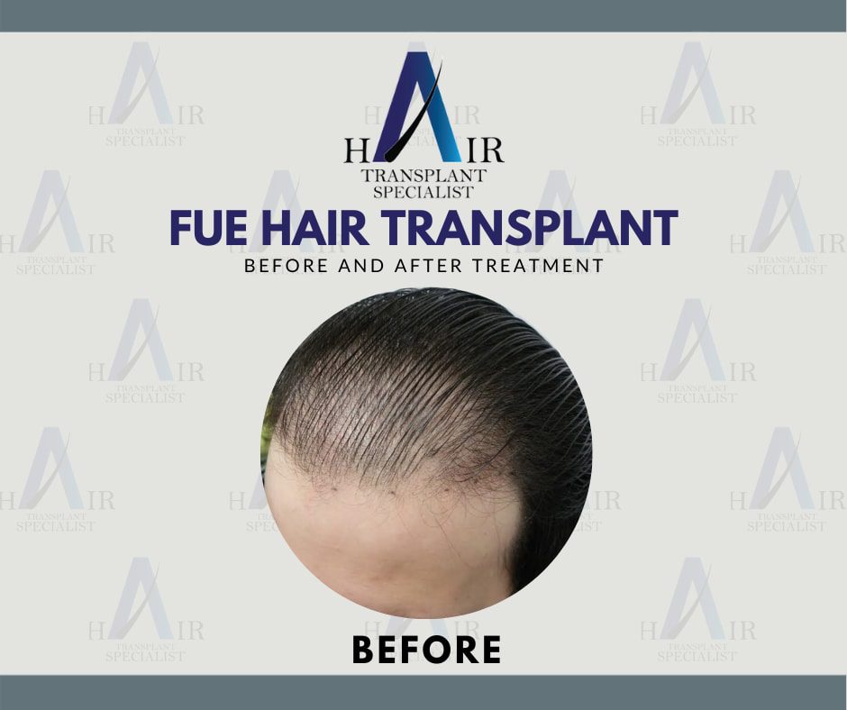 Pre-FUE treatment image displaying areas of sparse hair indicative of hair loss.