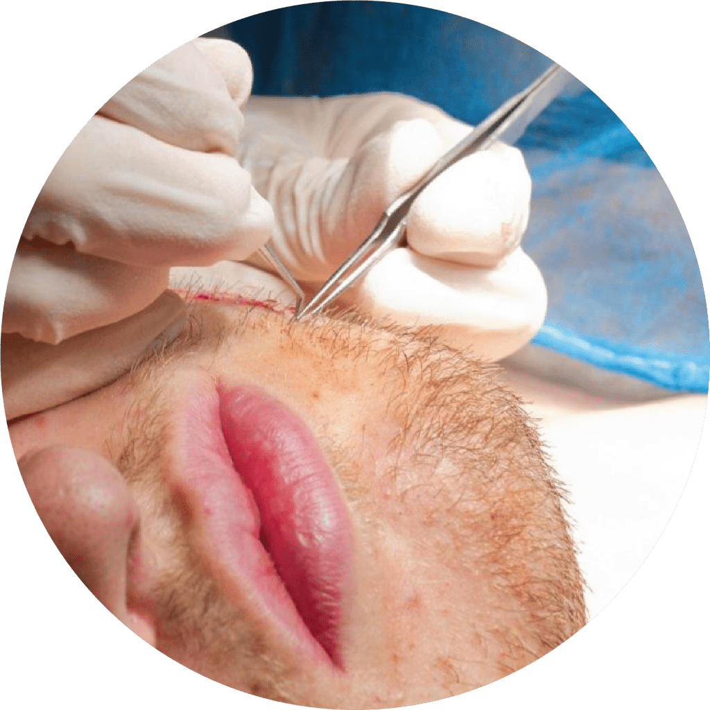 Photo of precise hair graft placement during a beard transplant procedure.