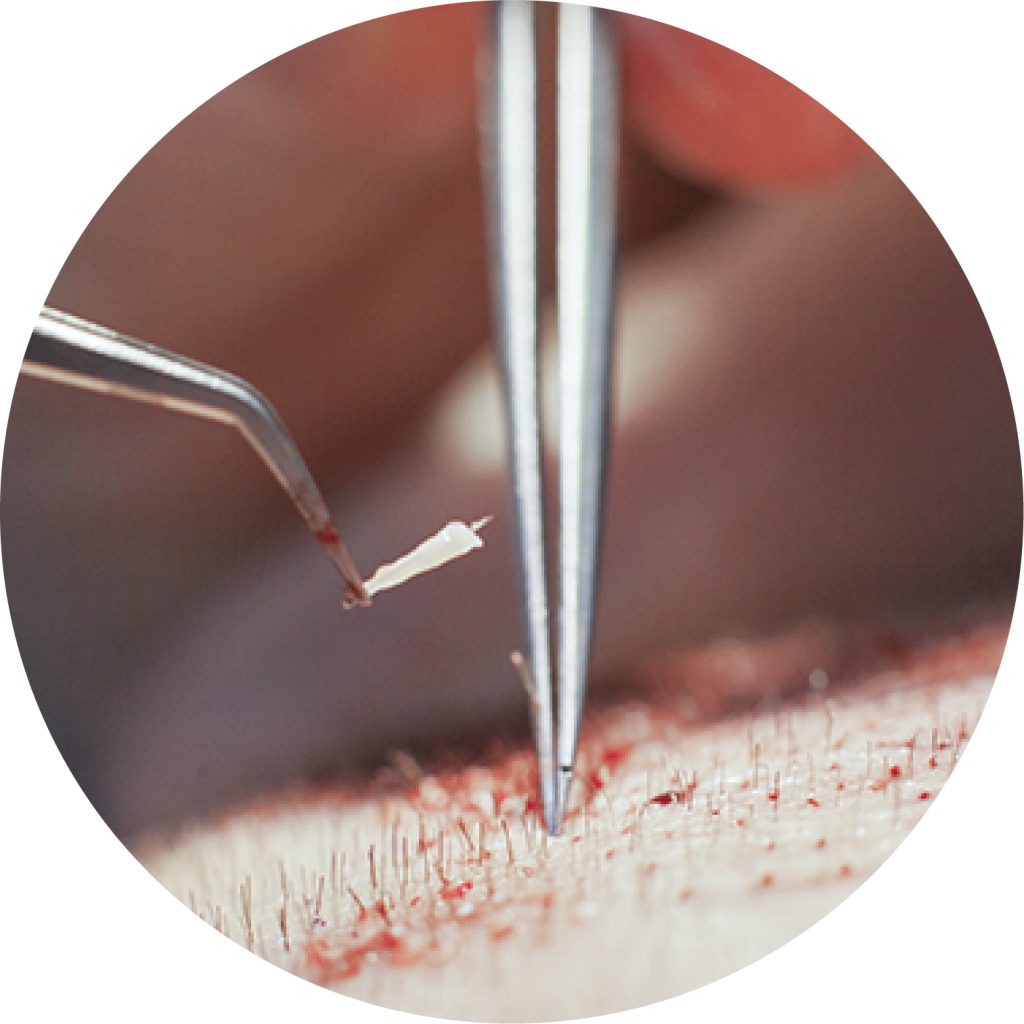 Close-up of surgical sutures being performed on skin with tweezers and a needle holder.