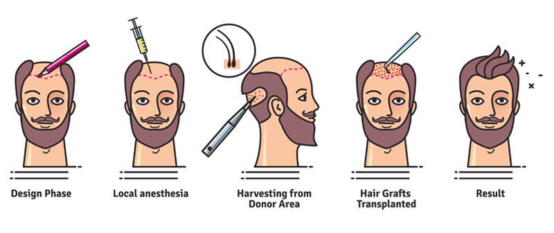 Illustration of hair transplantation stages from design to result.