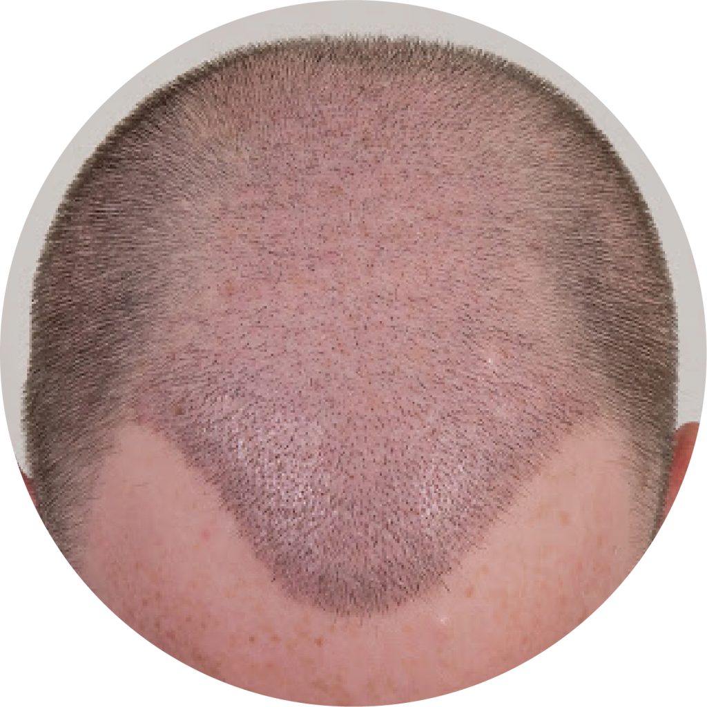 Close-up view of the top of a person’s head showing hair regrowth with short, dense hair follicles.