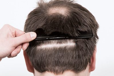 Back view of a male’s head showing the donor area post-hair transplant.