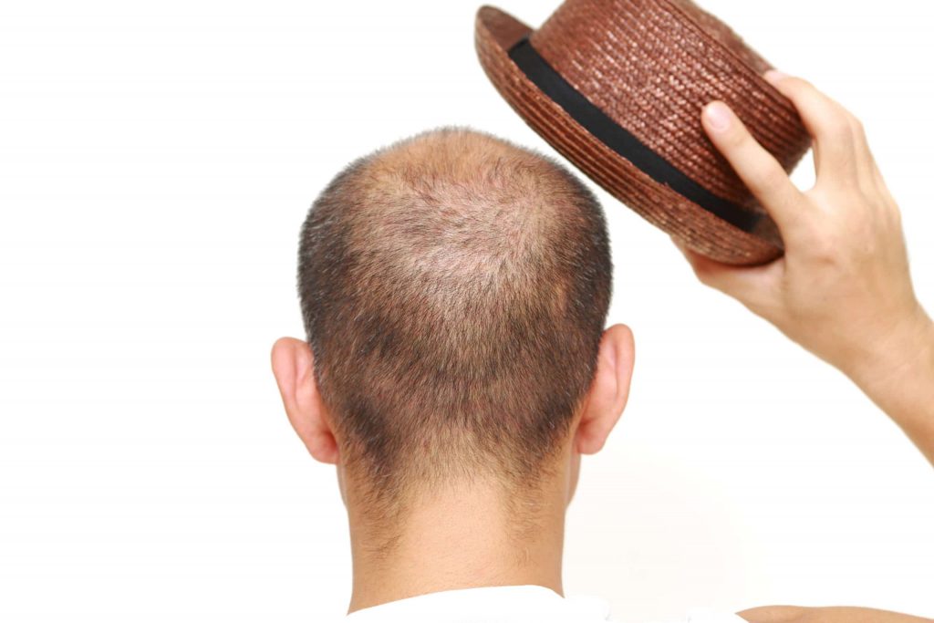 A person experiencing hair thinning wearing a stylish hat.