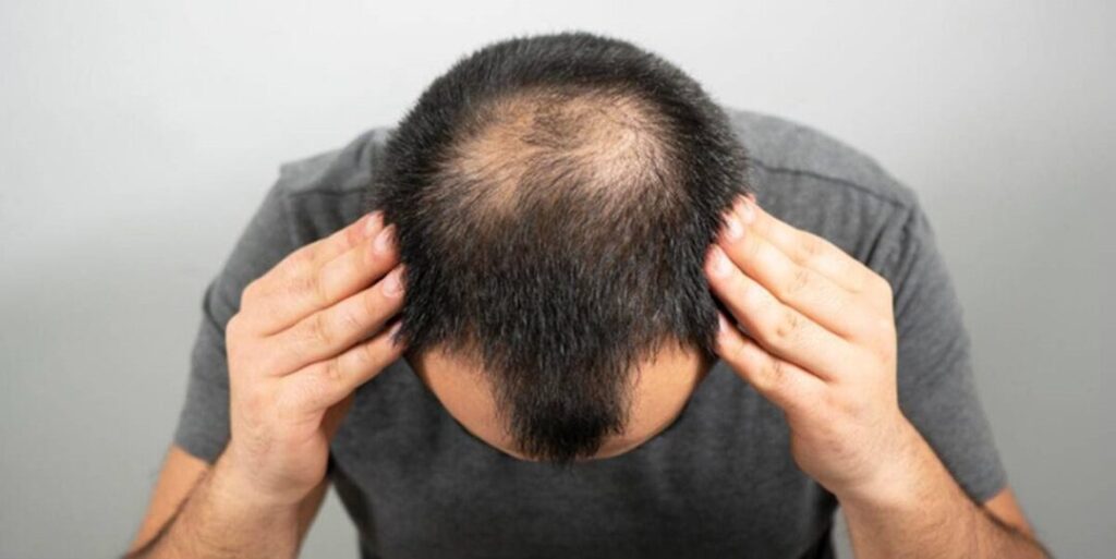 Man examining his receding hairline in the mirror.
